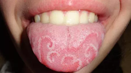 Geographic tongue