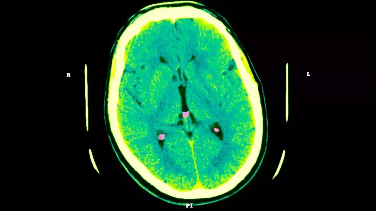 A strange brain disease is on the rise in Canada and has authorities worried