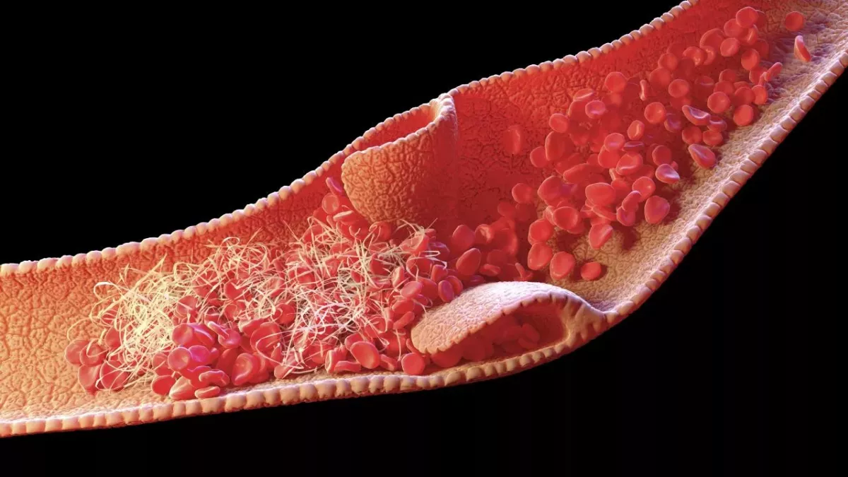 Venous thrombosis, what is it, and do COVID vaccines cause it?
