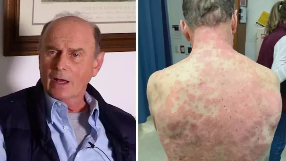 74-year-old patient sees skin 'peeling off' after being vaccinated