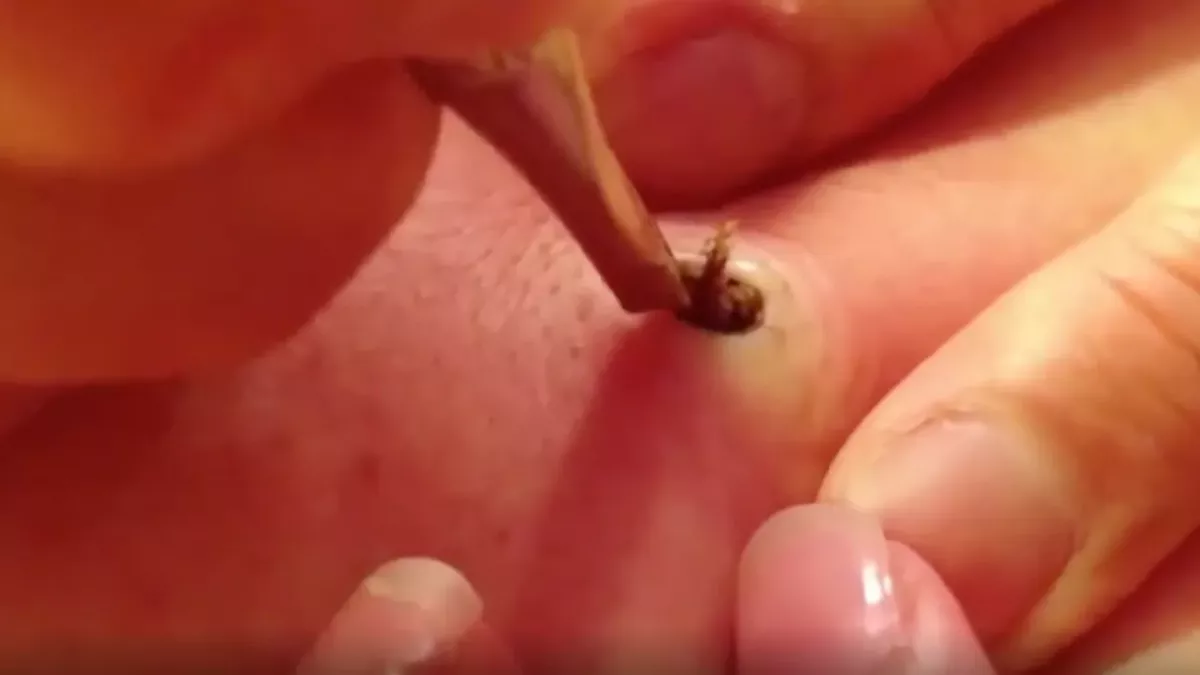 After 20 years, this woman finally gets rid of the pimple that was ruining her life
