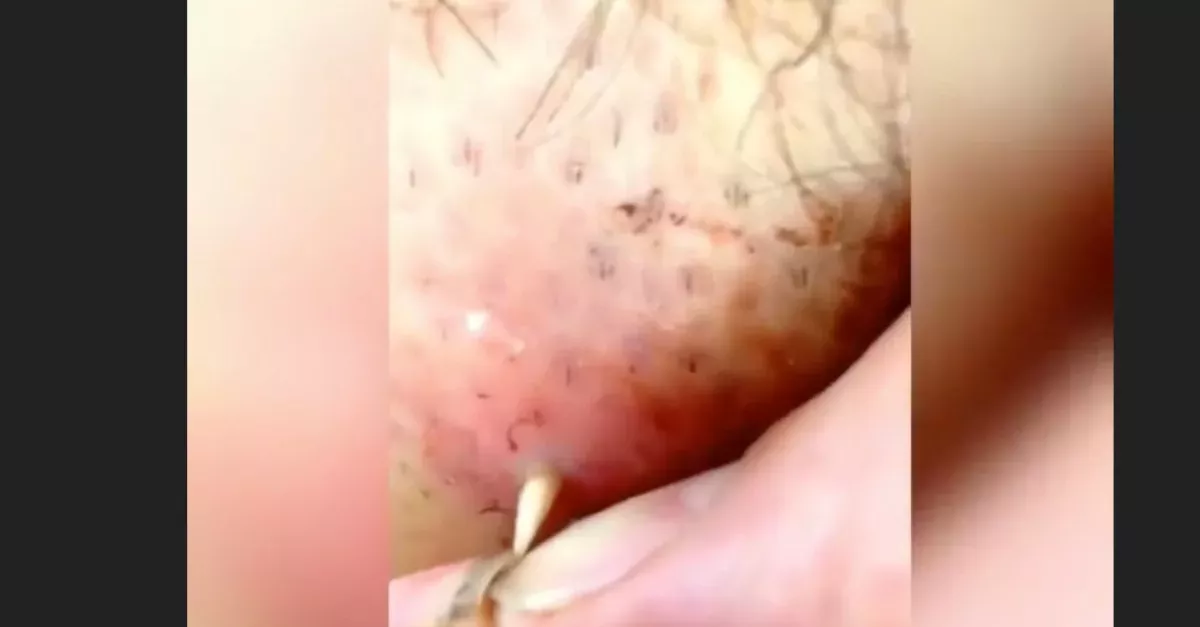 Botfly