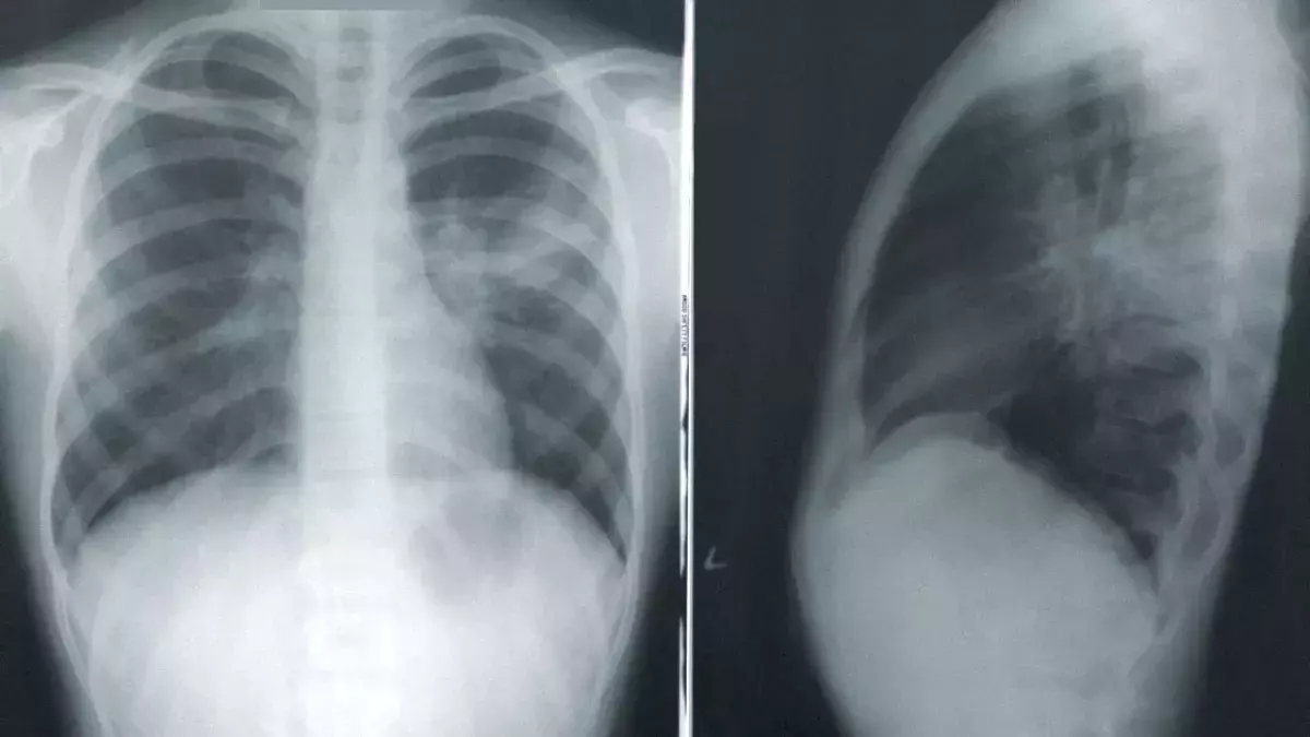 COVID complication 