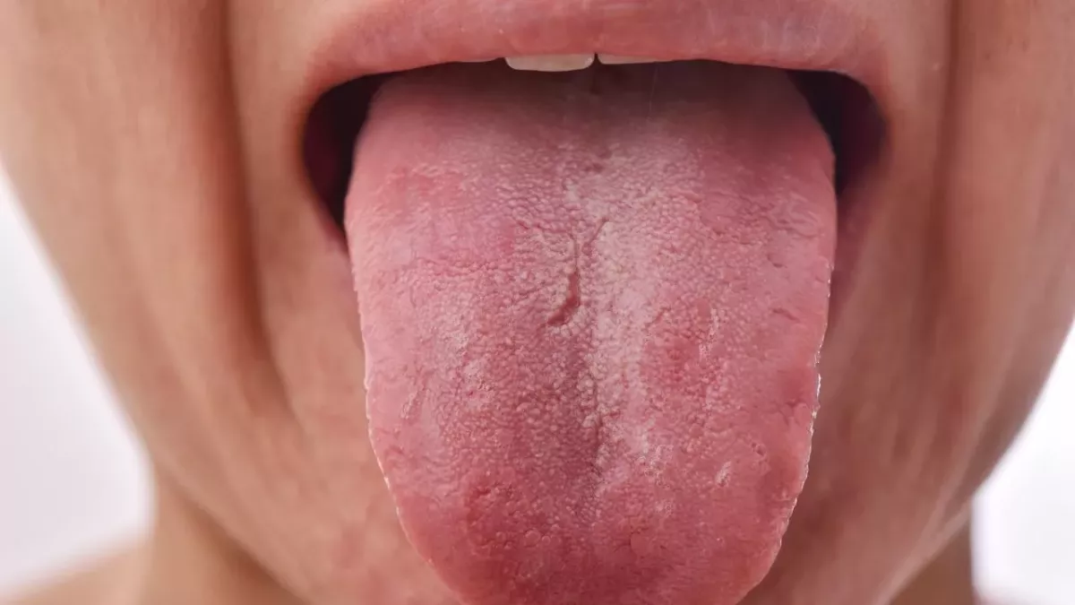 COVID Tongue: The Nasty New Coronavirus Symptom