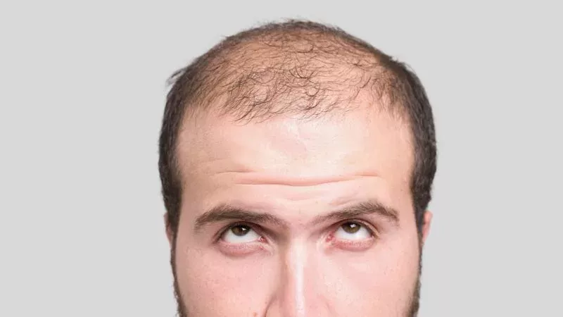 Hair Loss: Can You Fight Against It And Really Eradicate It?