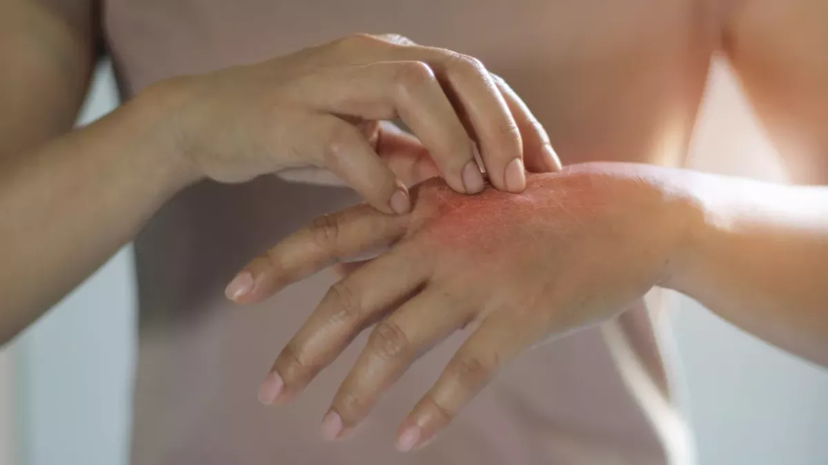 Skin irritations