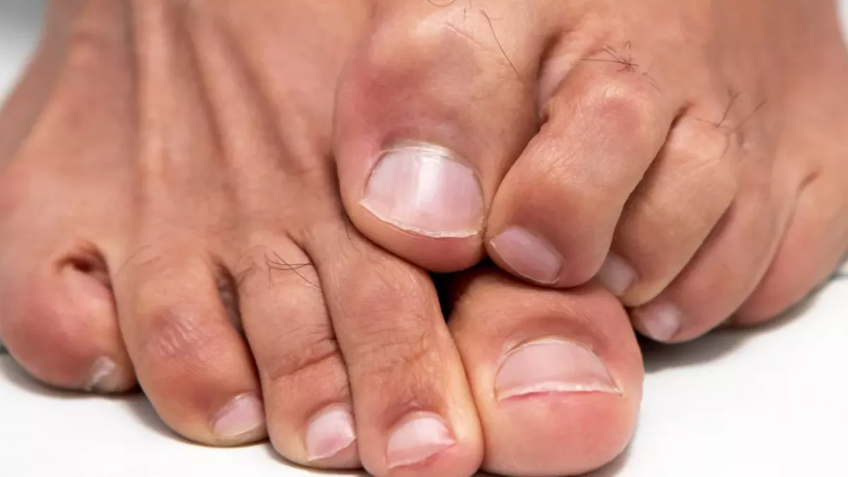 This is why you should never burst a 'pimple' on your feet 