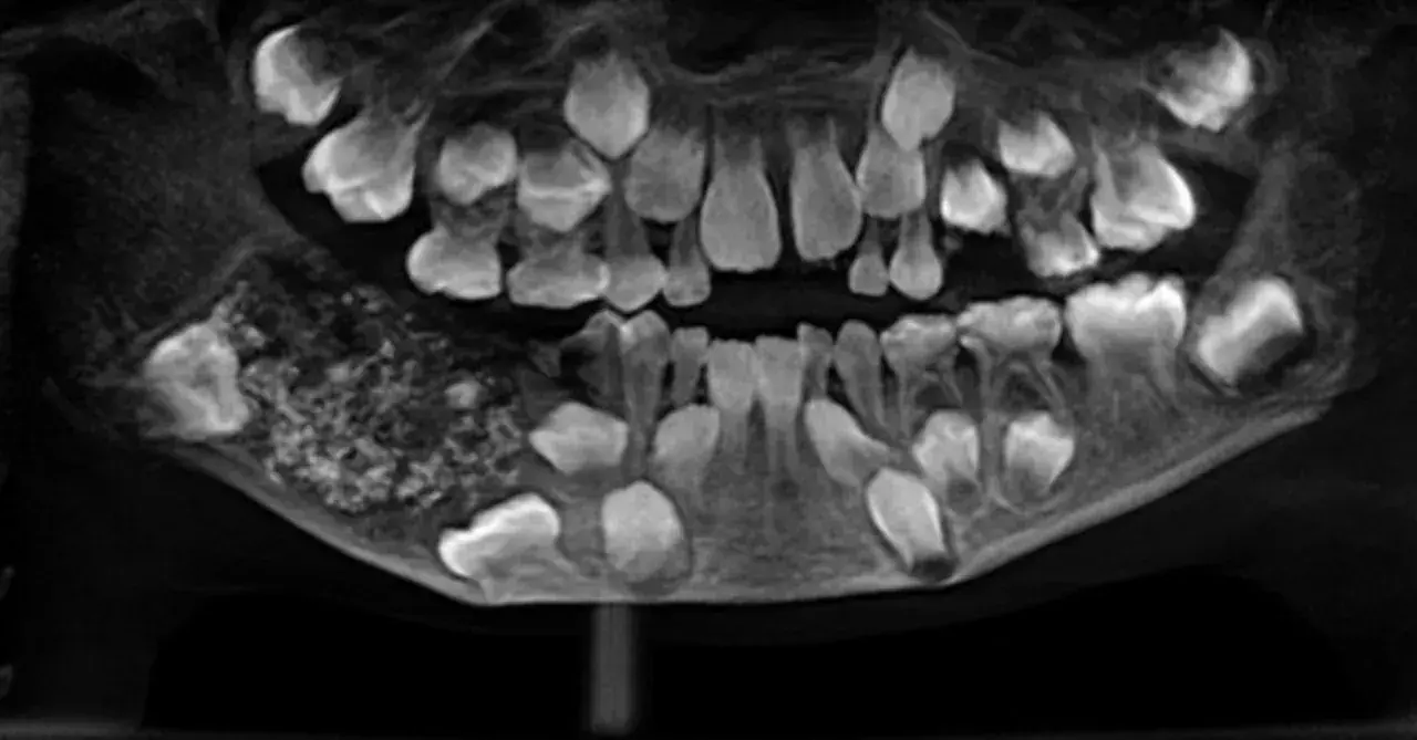 A young boy had 526 teeth removed from his mouth