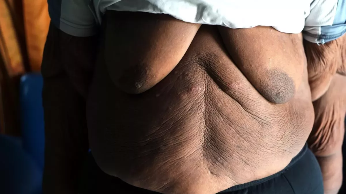 This morbidly obese Youtube stopped eating for 150 days to save his life