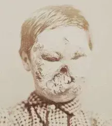 Zombies - In Italy during the Renaissance a syphilis epidemic caused several people’s bodies to be deformed. Symptoms that will definitely make you believe monsters exist…